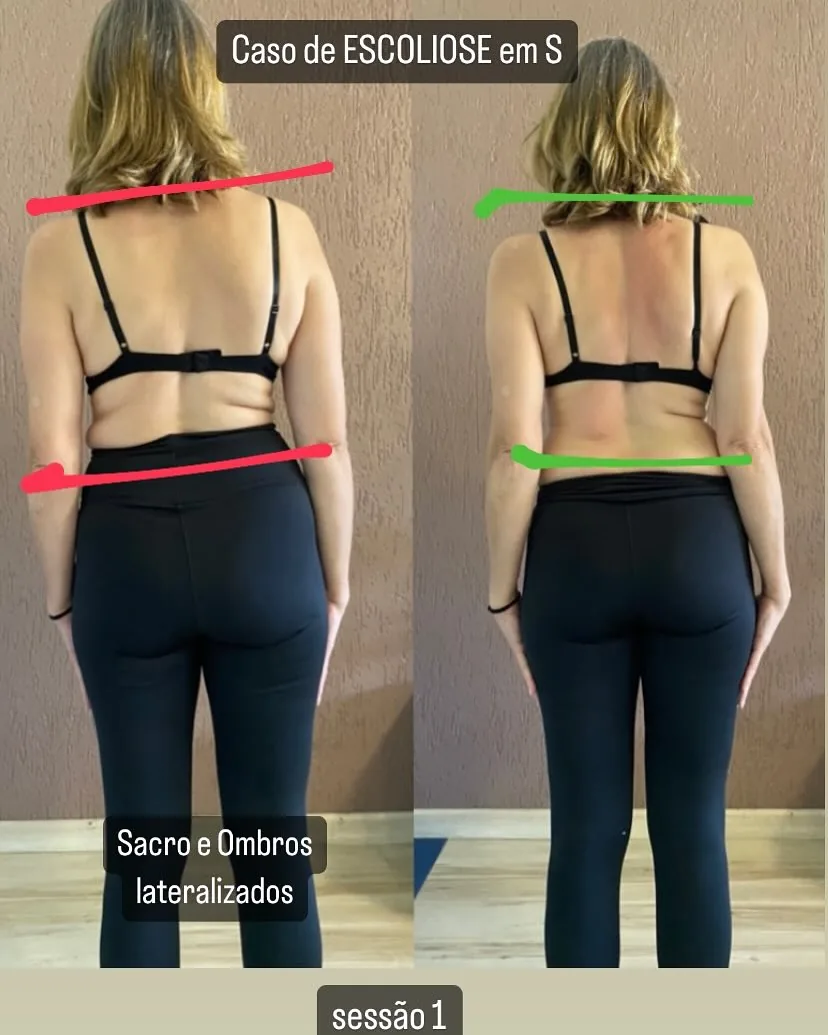 Costas de paciente com escoliose em S, antes e depois da primeira sessão